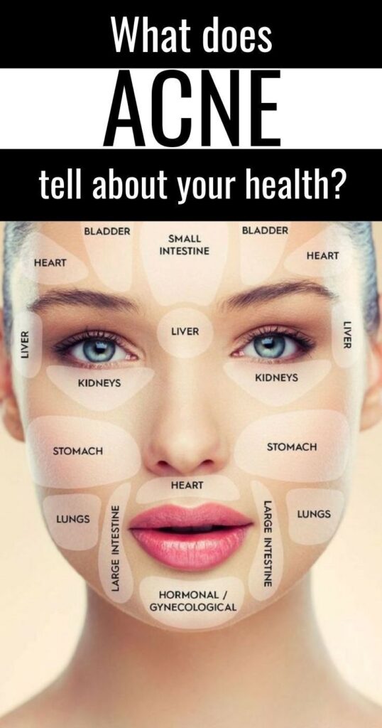 Acne, a multifaceted skin condition, arises from the obstruction of hair follicles by a combination of excess oil Acne, a multifaceted skin condition, arises from the obstruction of hair follicles by a combination of excess oil and dead skin cells. This obstruction manifests as whiteheads, blackheads, or inflamed pimples. While commonly associated with adolescence, Root Causes of Acne,acne affects individuals across all age groups.

While effective treatments exist, managing acne can prove challenging due to its persistent nature. Lesions heal slowly, often leaving behind scars, and new eruptions frequently appear as existing ones resolve. lets find more about Root Causes of Acne,

Beyond its physical manifestations, acne can significantly impact emotional well-being, exacerbating stress and self-image concerns. Timely intervention is crucial to mitigate these effects and minimize long-term skin damage.